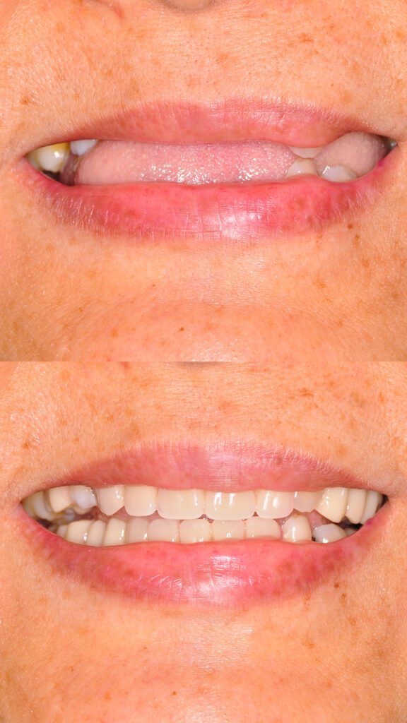 dental implants damansara heights, bukit damansara