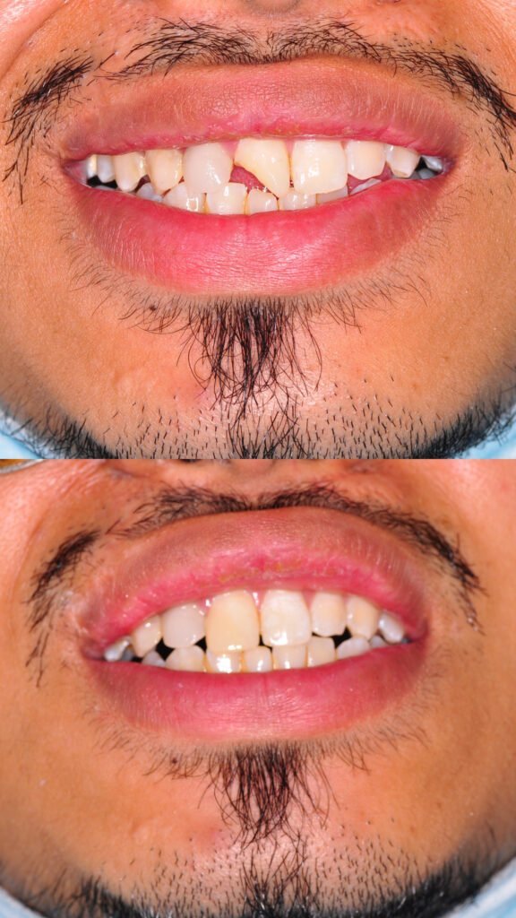 dental fillings damansara heights, bukit damansara