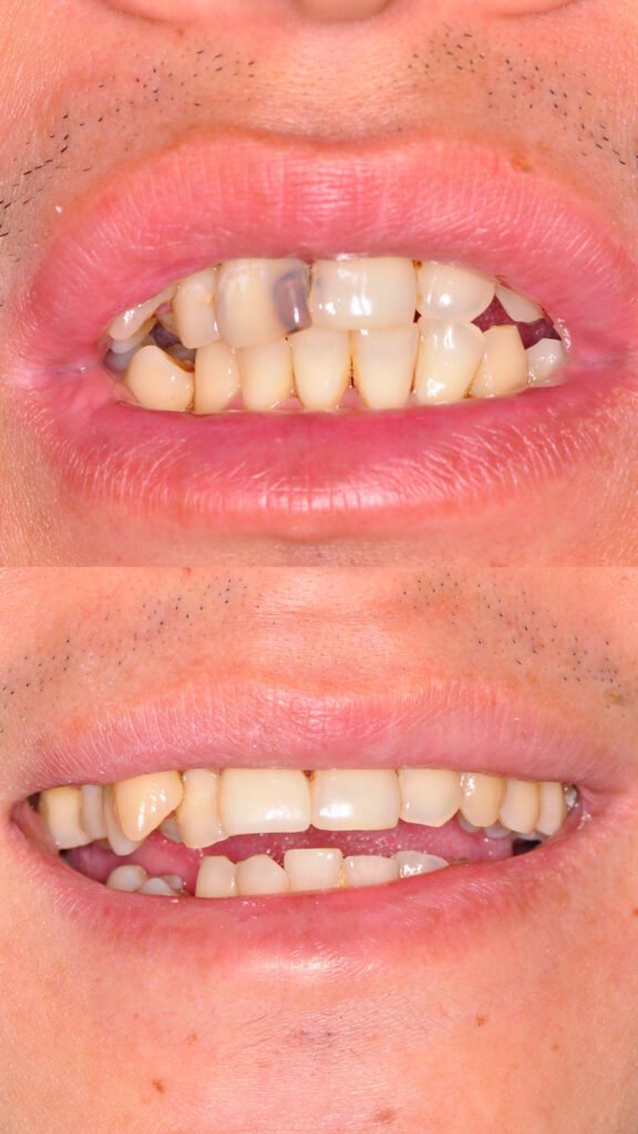 teeth scaling damansara heights