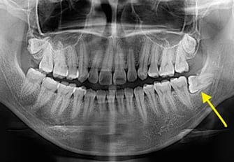 Wisdom Tooth Removal damansara heights