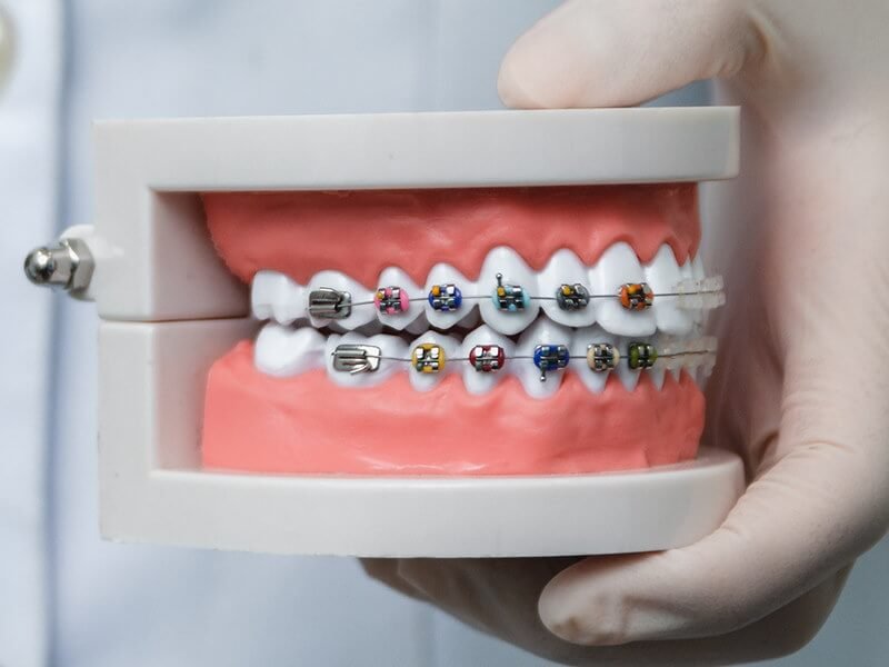 braces & orthodontics damansara heights, bukit damansara