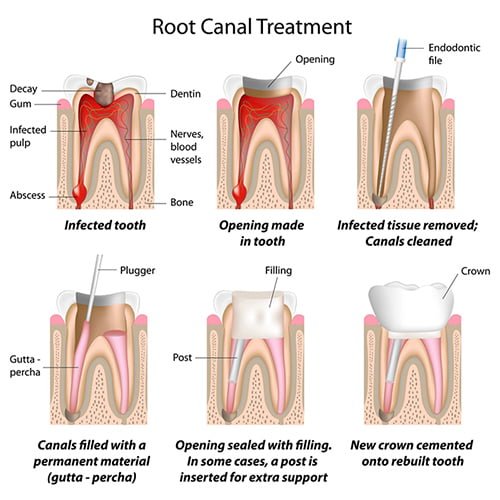 root canal treatment damansara heights, bukit damansara