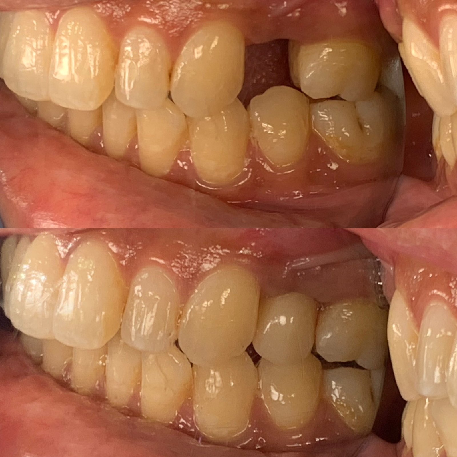dental implant