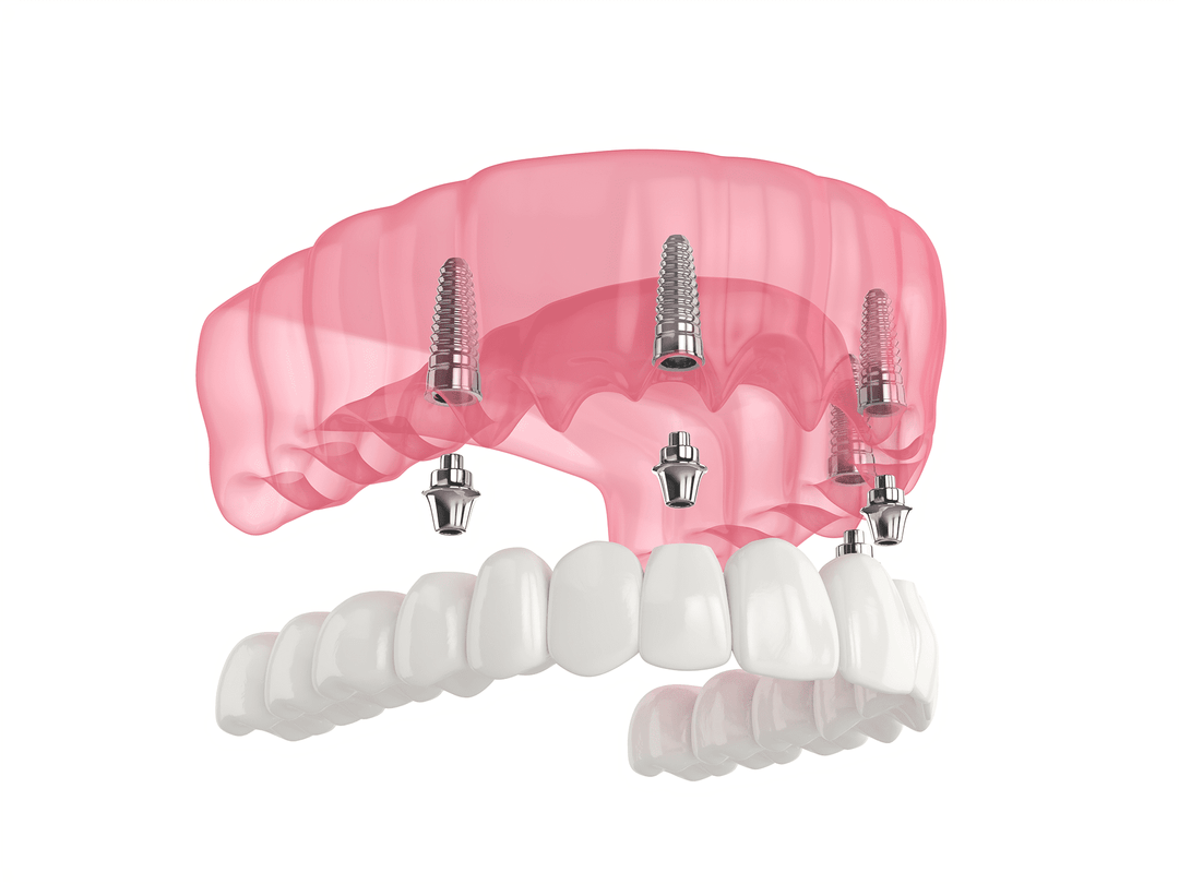 all on 4 implant