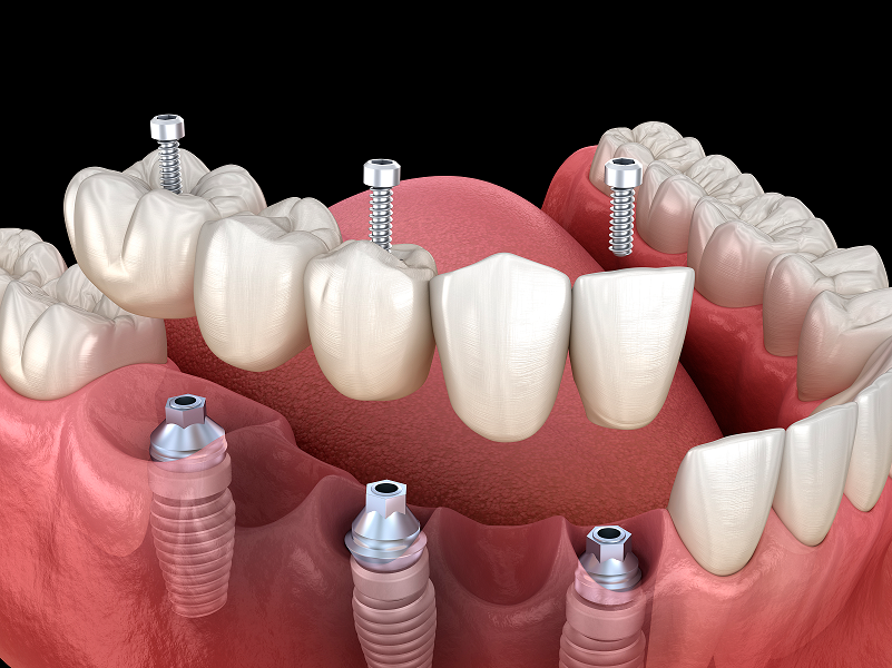 implant supported bridge