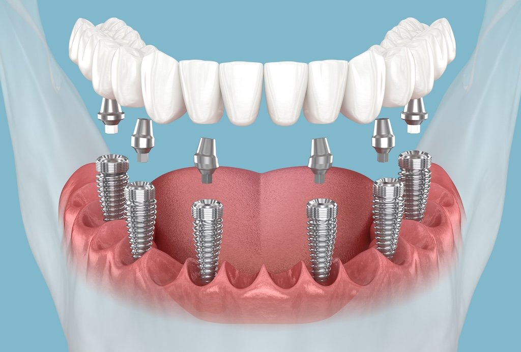 all on 6 dental implants
