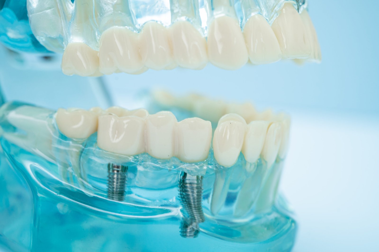 full mouth dental implant