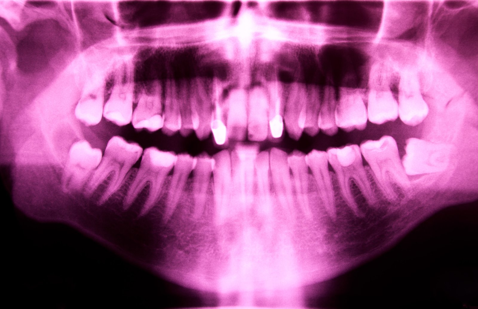 slows down bone loss teeth