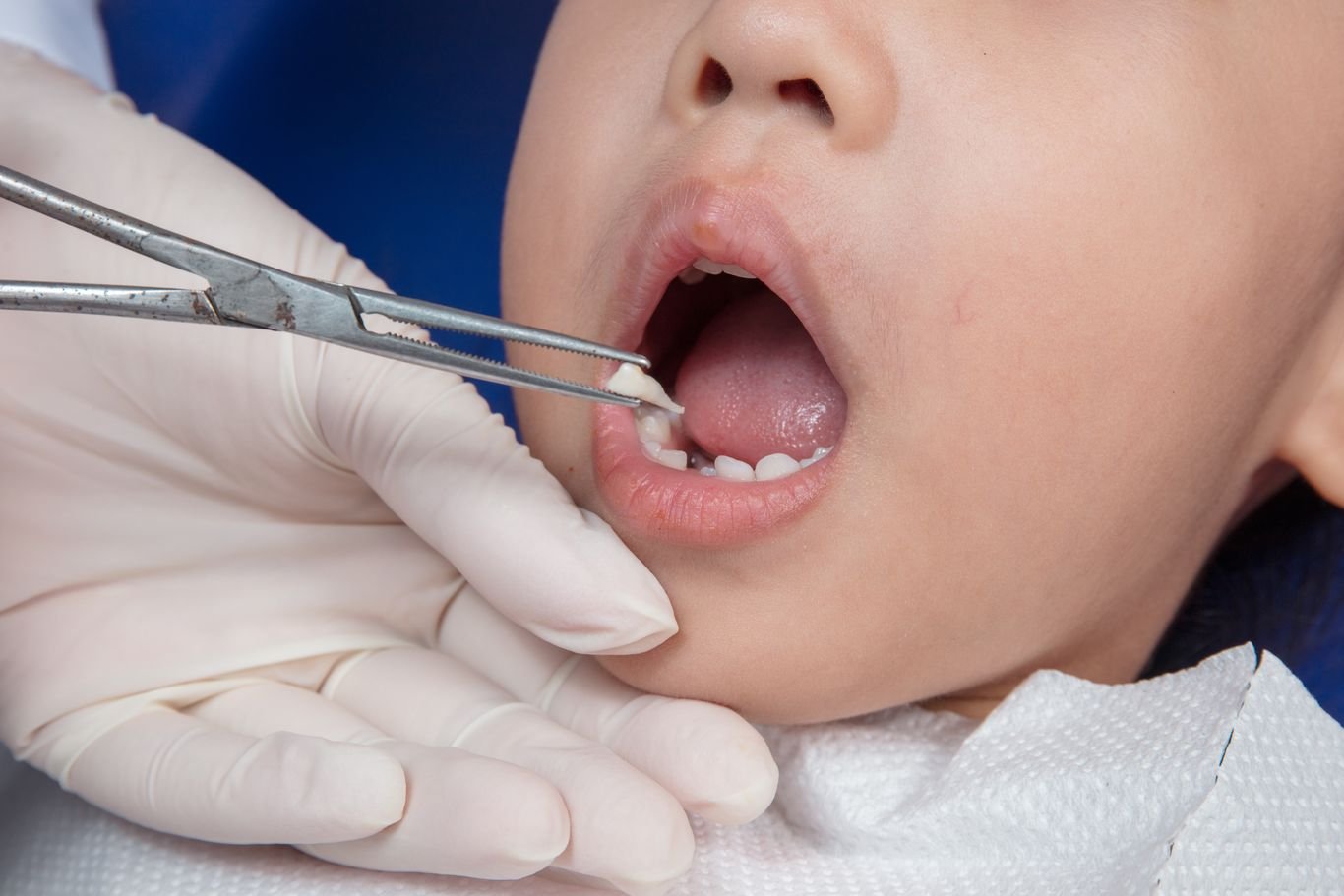 tooth gap teeth extraction