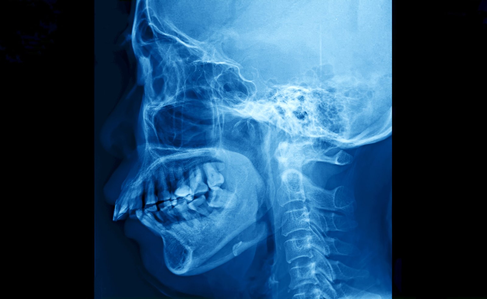 jawbone support
