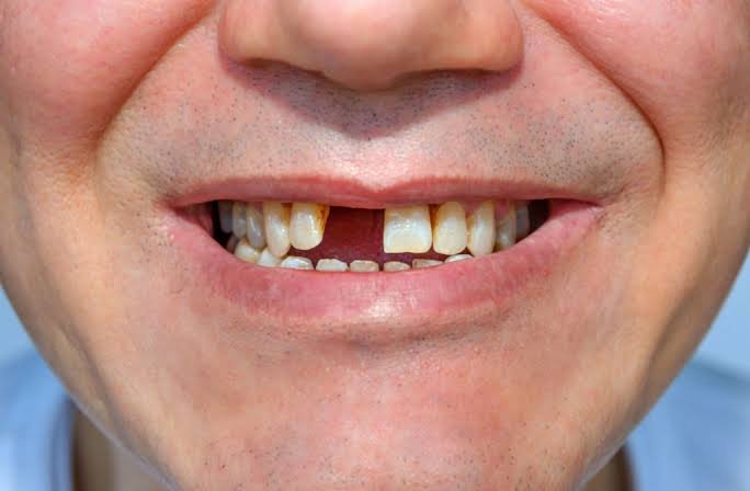 missing tooth